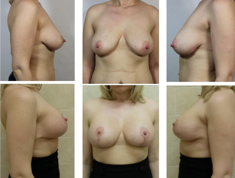 Каплевидное увеличение груди