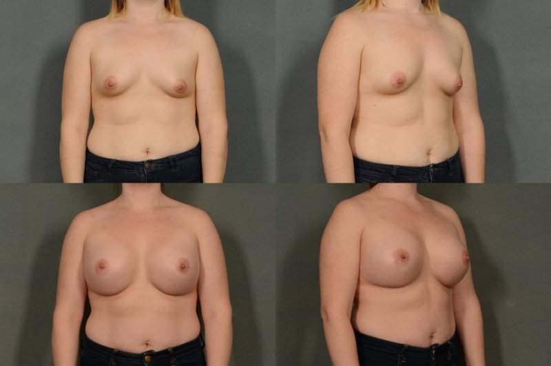 Обычная грудь