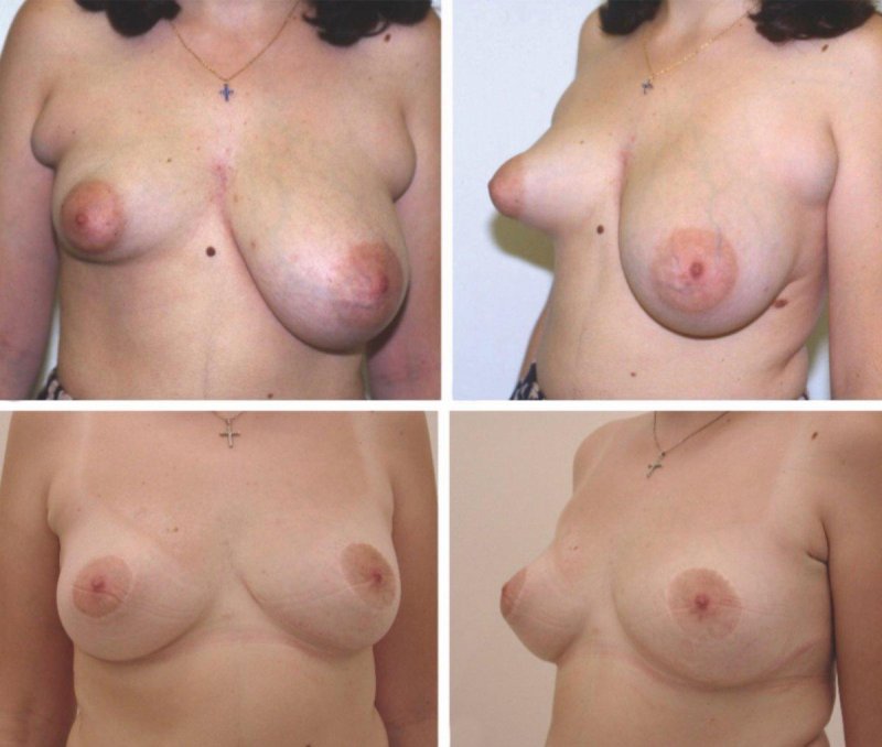 Периареолярная мастопексия