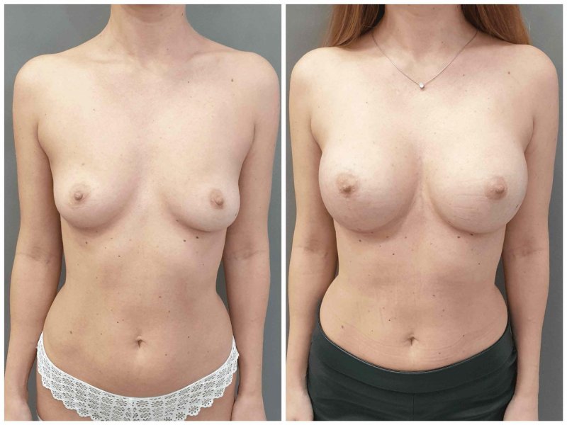 Грудь с круглыми имплантами