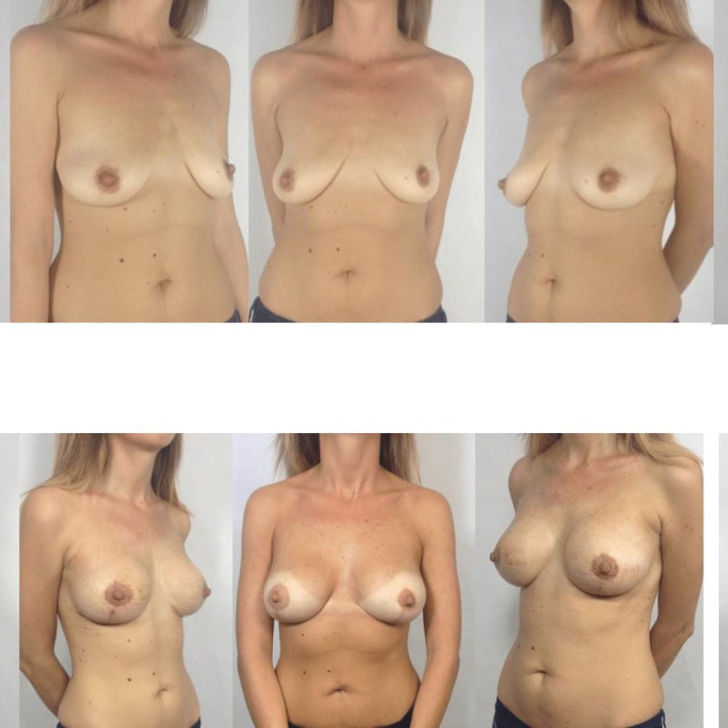 Пластика груди