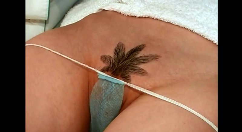 Интимная депиляция