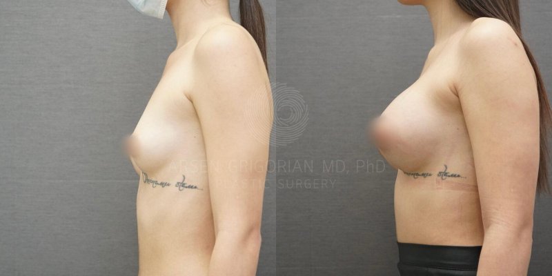 Тубулярная маленькая грудь