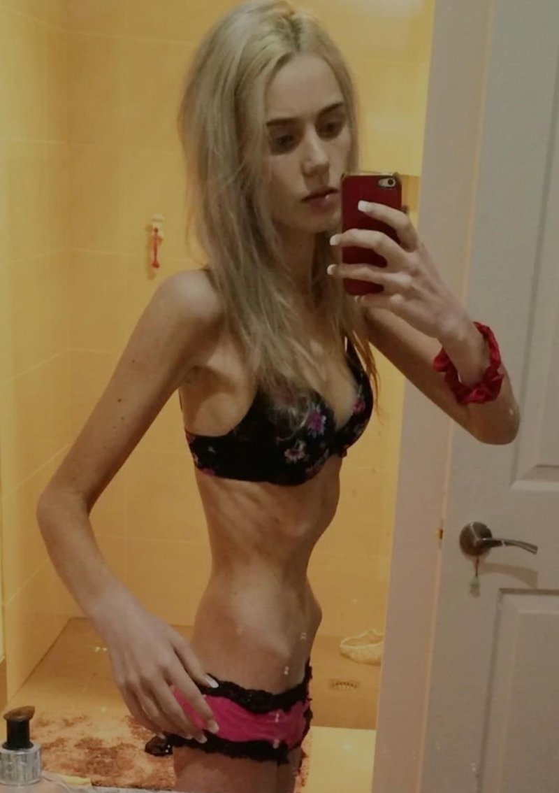 Девушка с анорексией