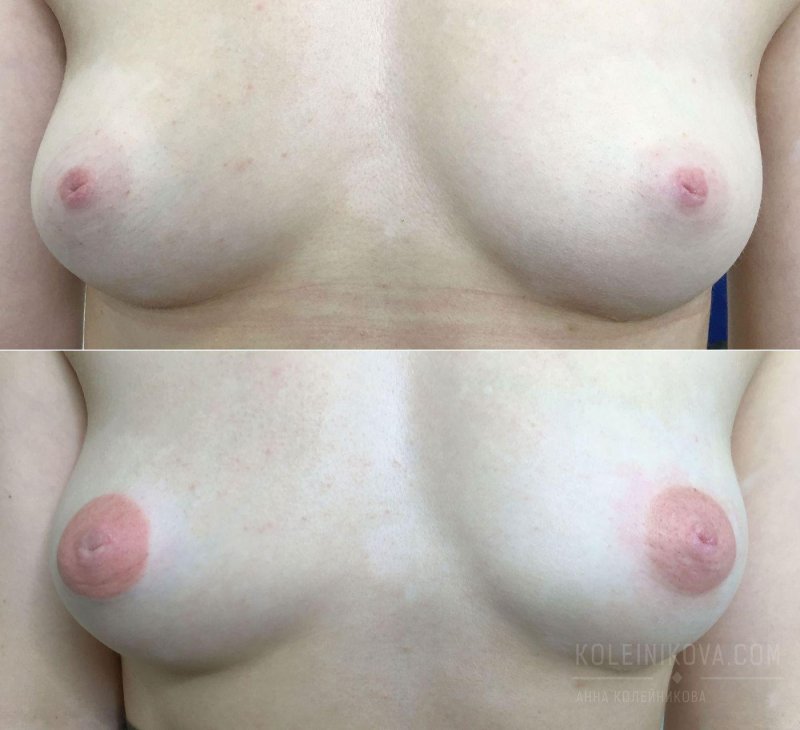 Увеличение груди