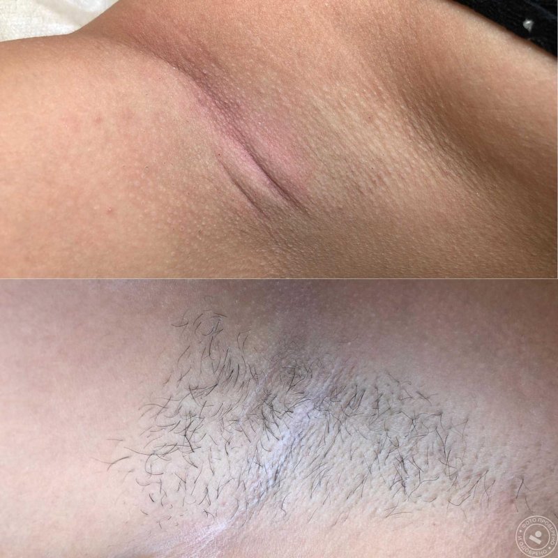 Шугаринг глубокого бикини