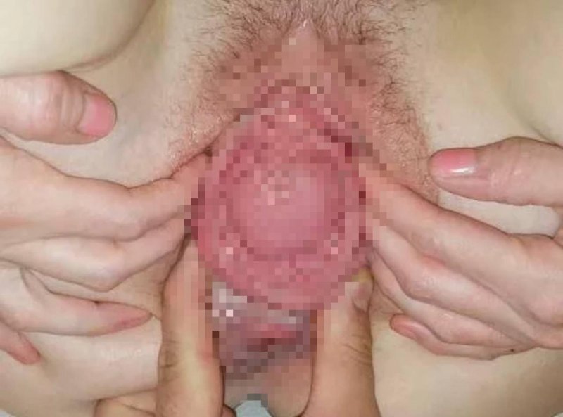 Влагалище с маткой наружу