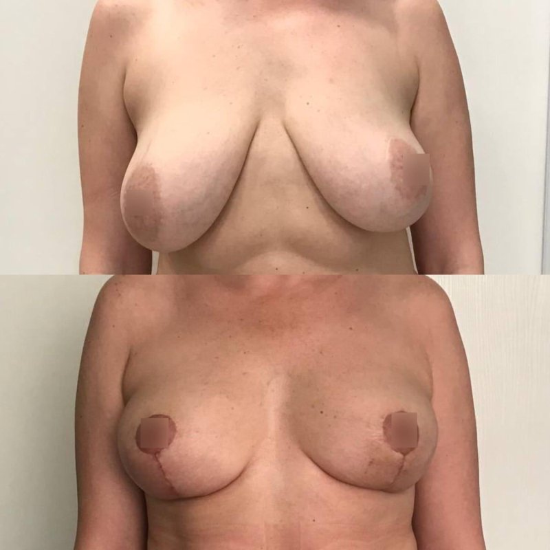 Уменьшение груди