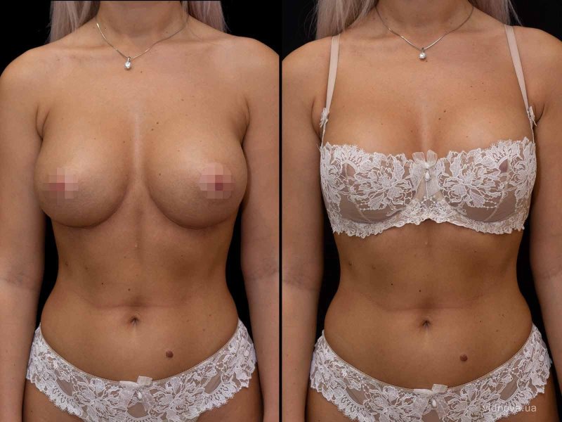 До и после увеличения груди