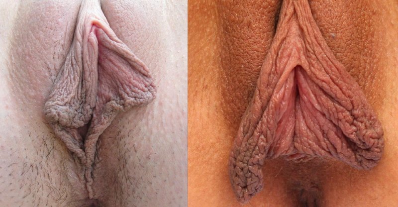 Очень большие половые губы