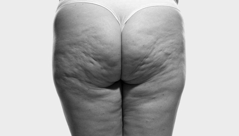 Антицеллюлитный массаж до и после