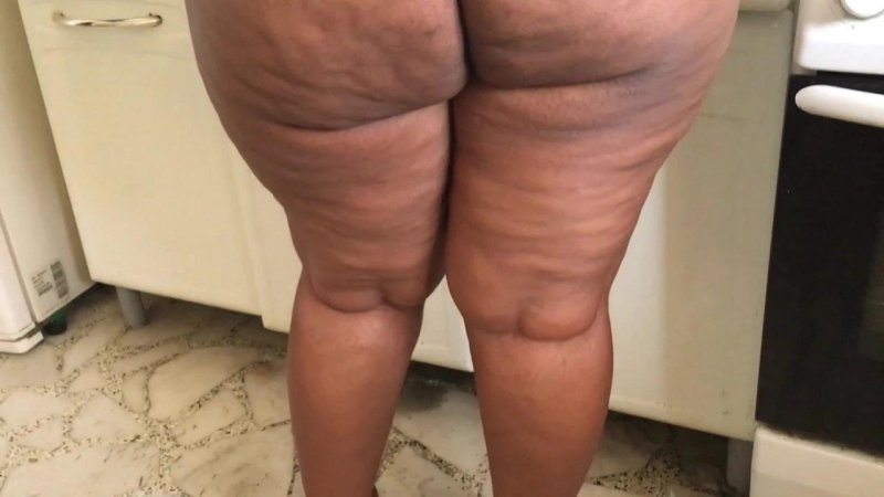 Липодистрофия целлюлит