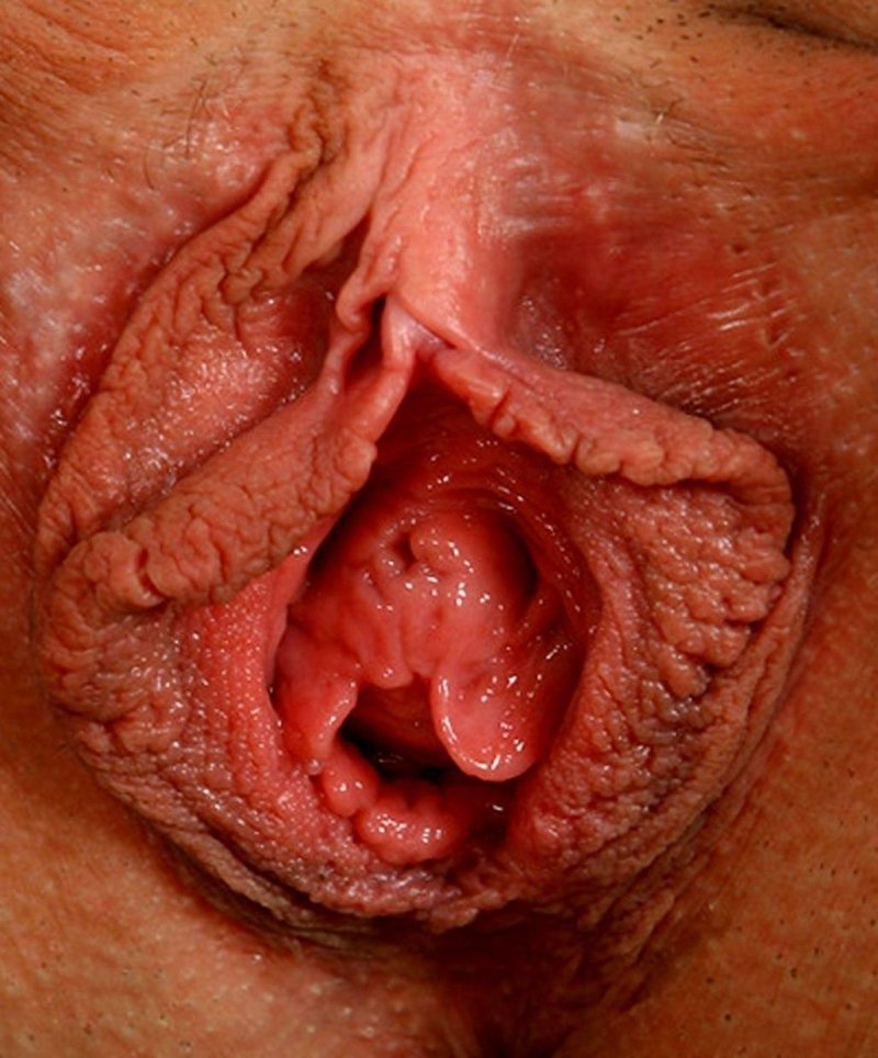 Остроконечные кондиломы