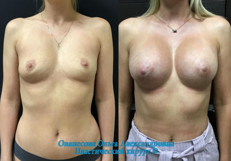 Пластика груди