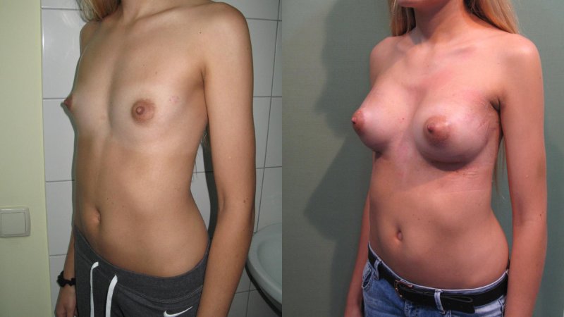 Грудь пластика