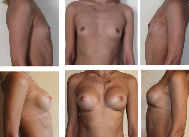 Необычная форма груди