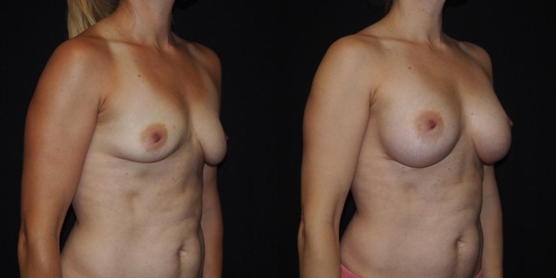 Breast reduction dr. richard