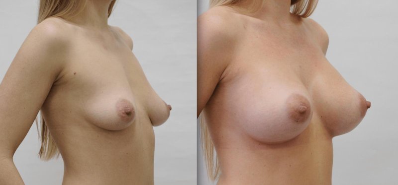 Конусообразная грудь