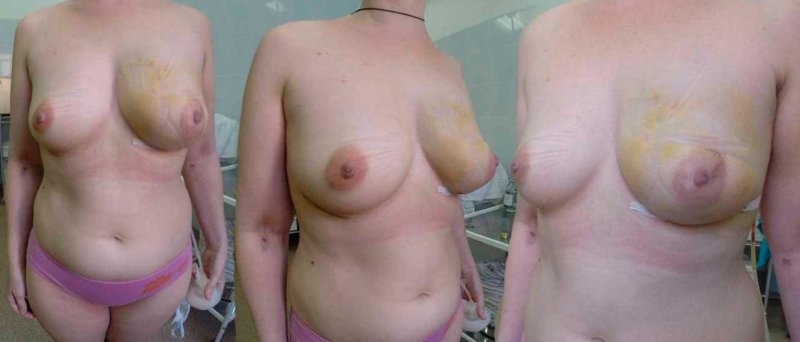 Голая грудь после родов