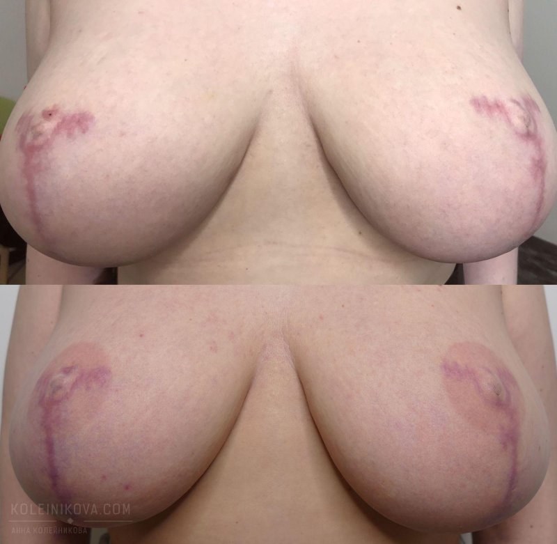 Татуаж Сосково ареолярного