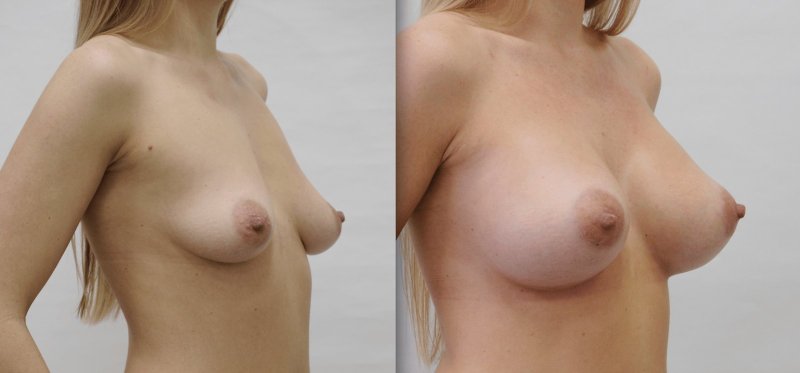 Конусообразная грудь